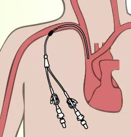 Long Term Intravenous Catheters