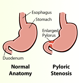 pyloric stenosis