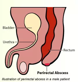 Perirectal Abscess