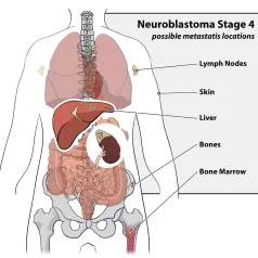 Neuroblastoma Stage 4