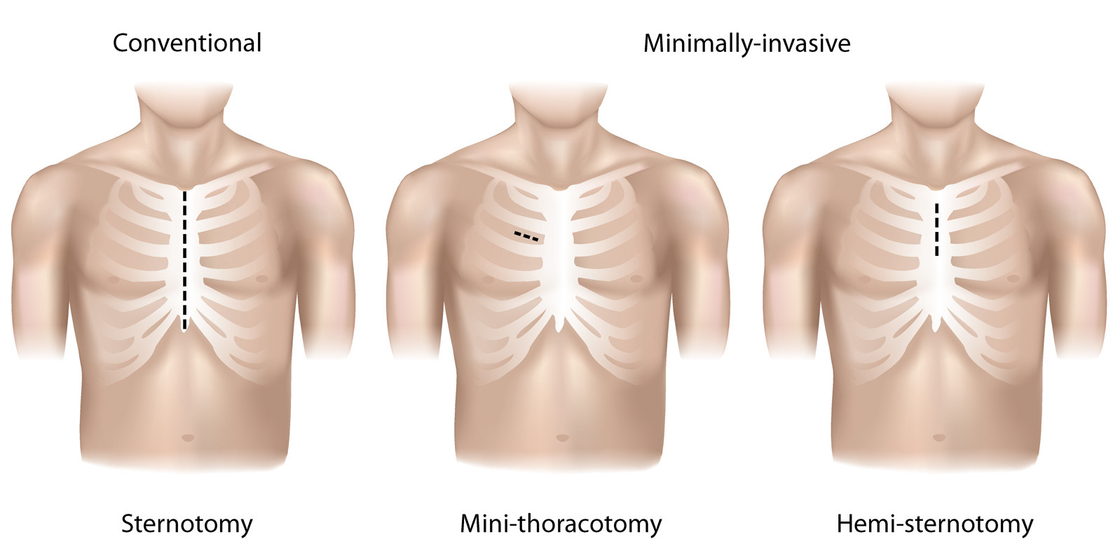 Minimally Invasive Aortic Valve Surgery | UCSF Department of Surgery
