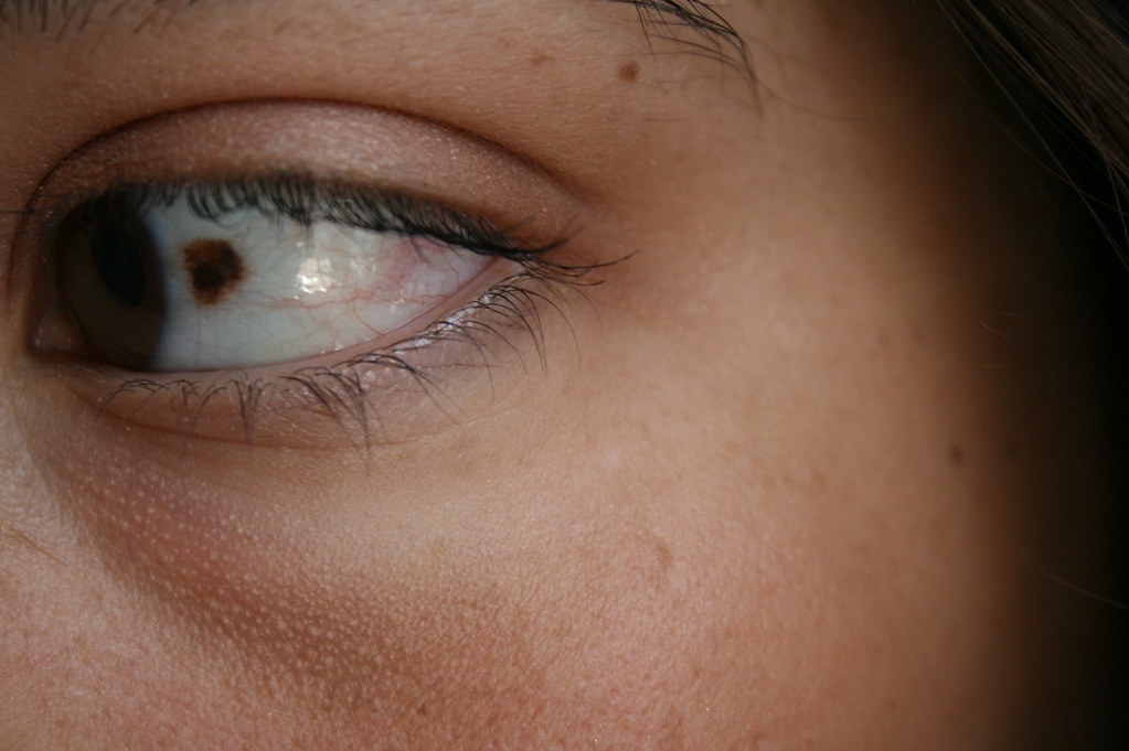 Birthmark