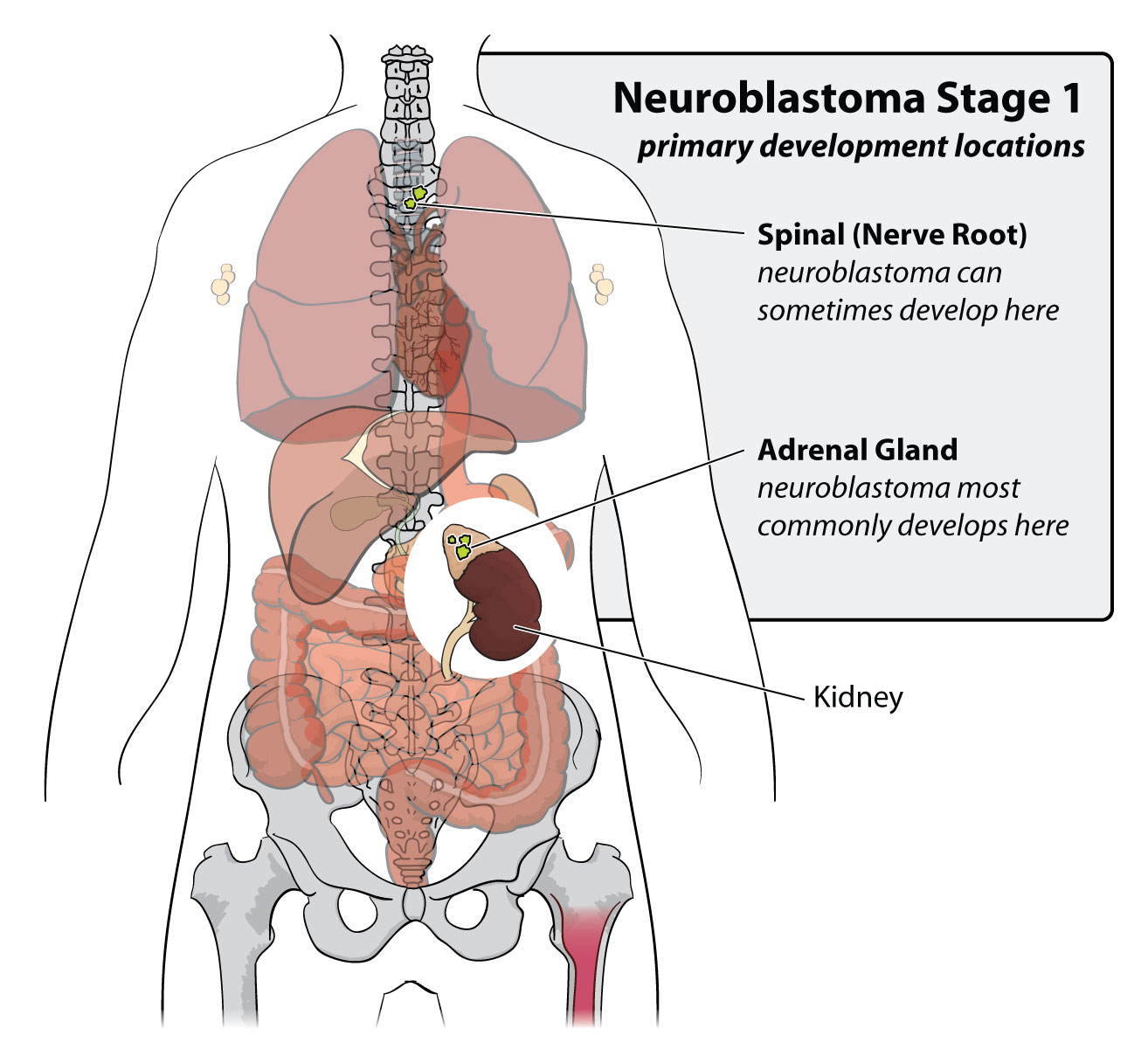 Neuroblastoma Stage 1 primary development locations