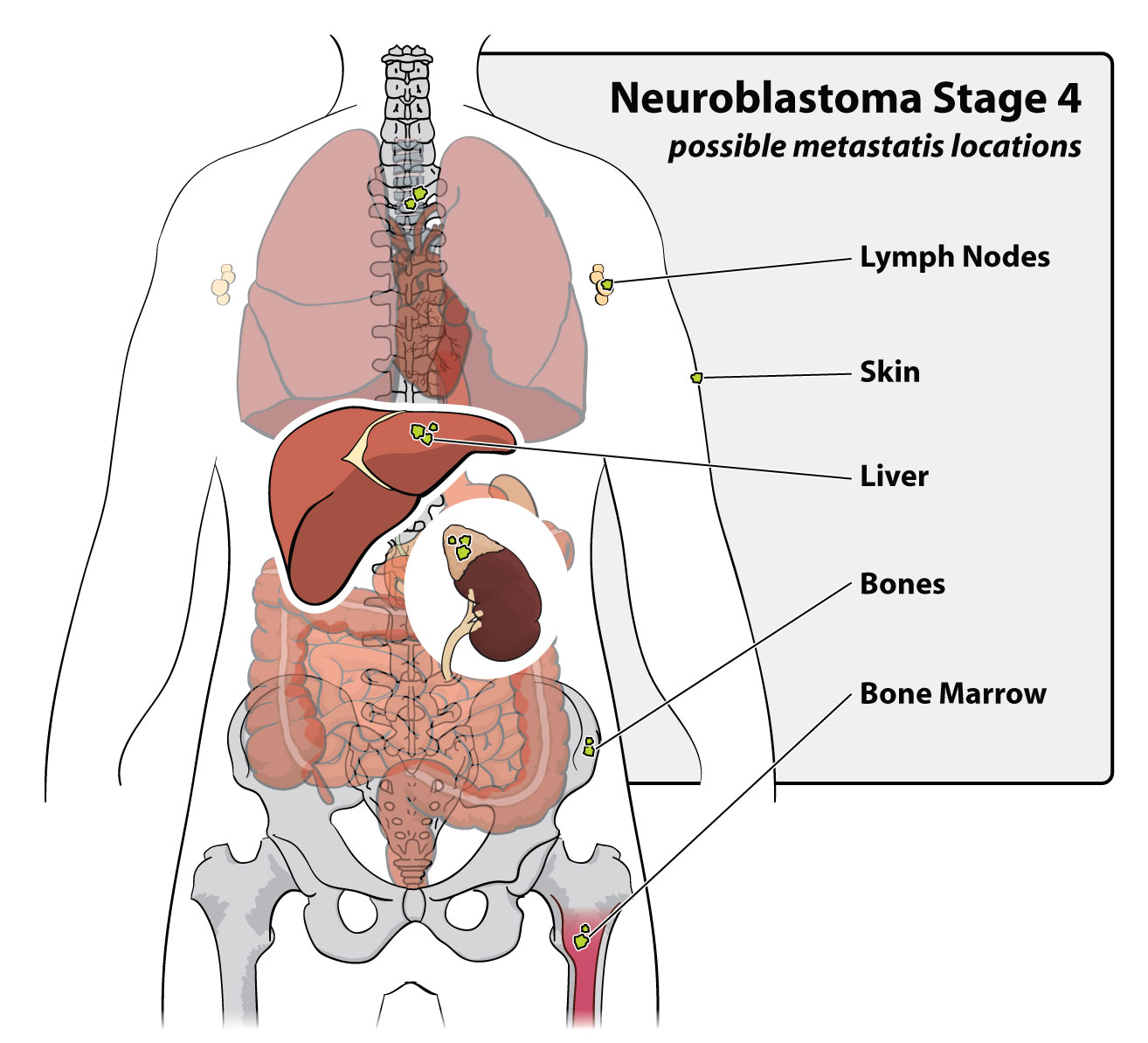 Neuroblastoma Stage 4 possible metastasis locations