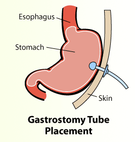 Gastronomy tube placement illustration