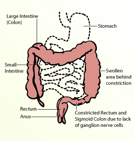 Hirschsprung's Disease illustration